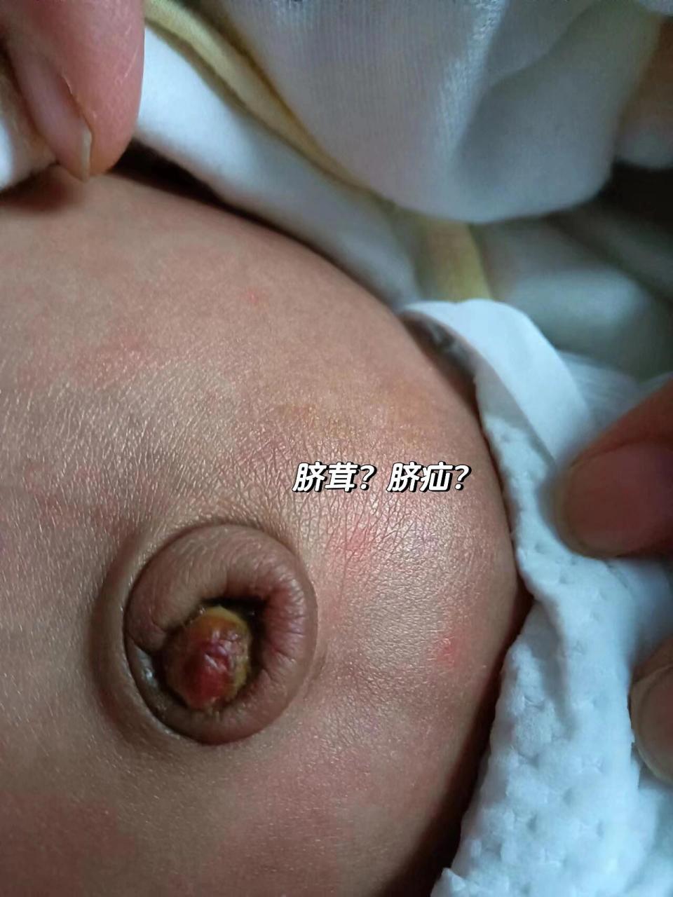 不一定是脐茸呢 宝宝脐带20天脱落后,有个红色的肉肉,妇幼保健院说是