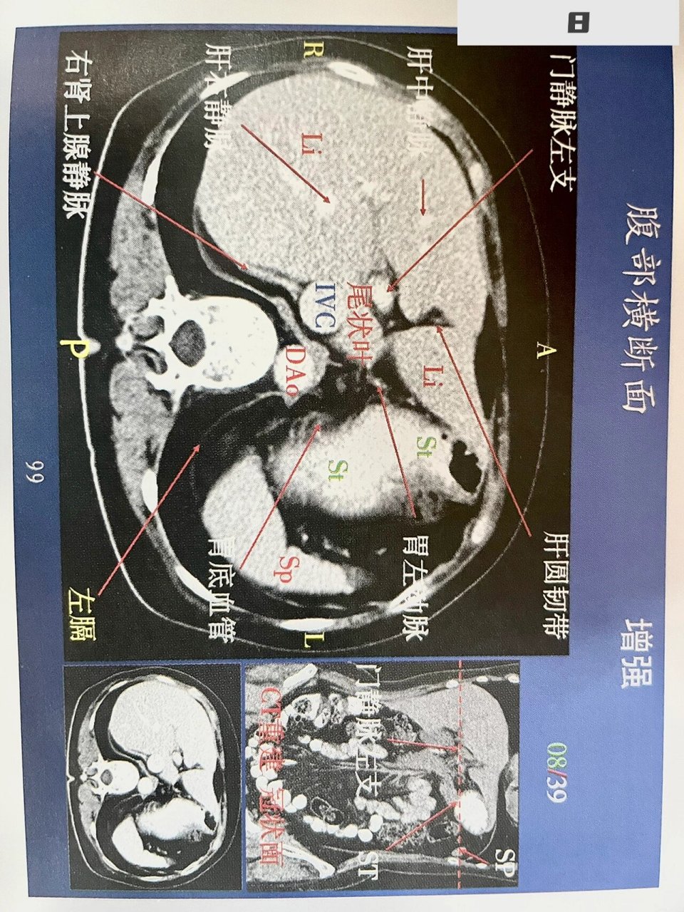 第一肝门横断面图片