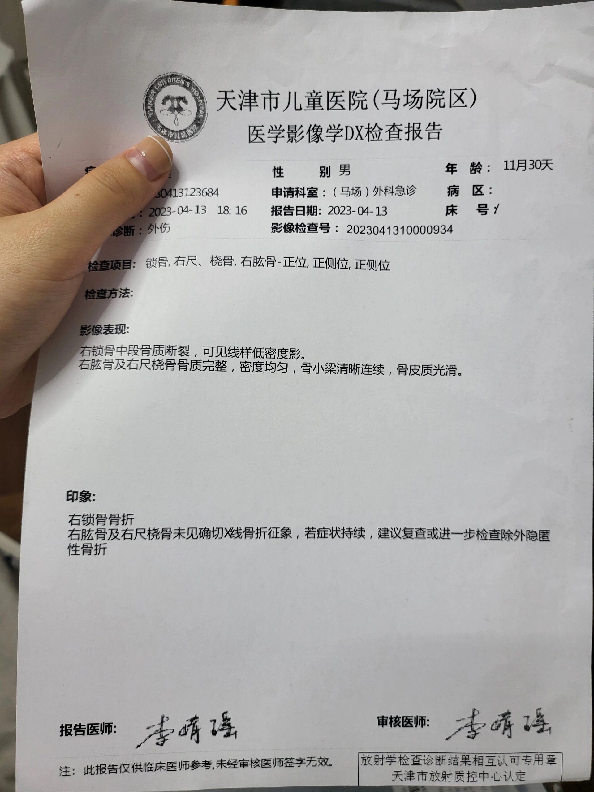 坠床哭闹不止,确诊锁骨骨折(附注意事项) π一岁生日前一天(4月13日)