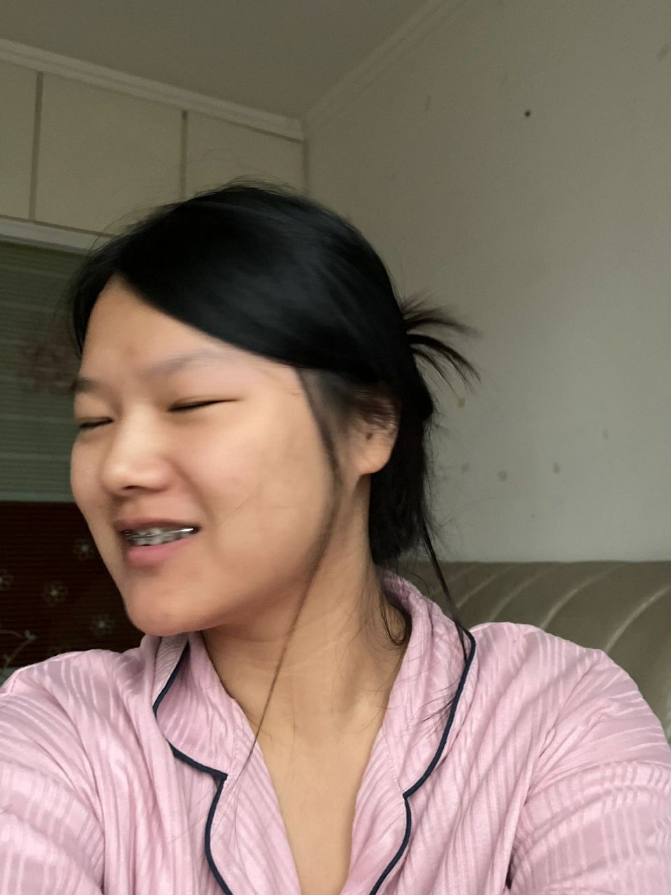 瘪嘴照片更新 正畸瘪嘴,太丑了!