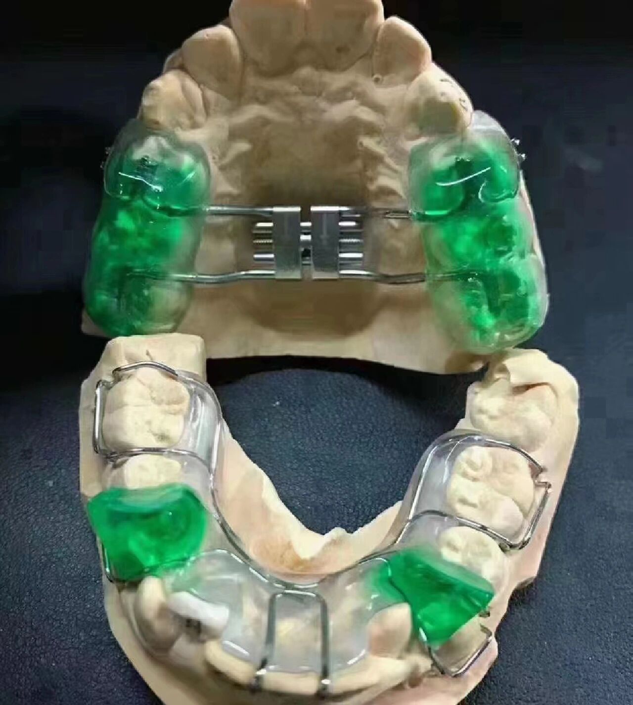 牙齿矫正 sgtb矫正器 也称双导面矫正器77快速扩弓器 适合12～20岁