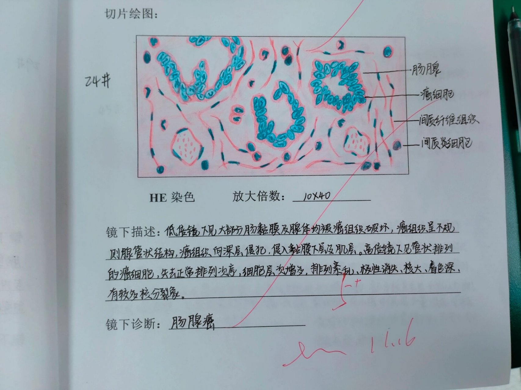 直肠腺癌红蓝铅笔绘图图片