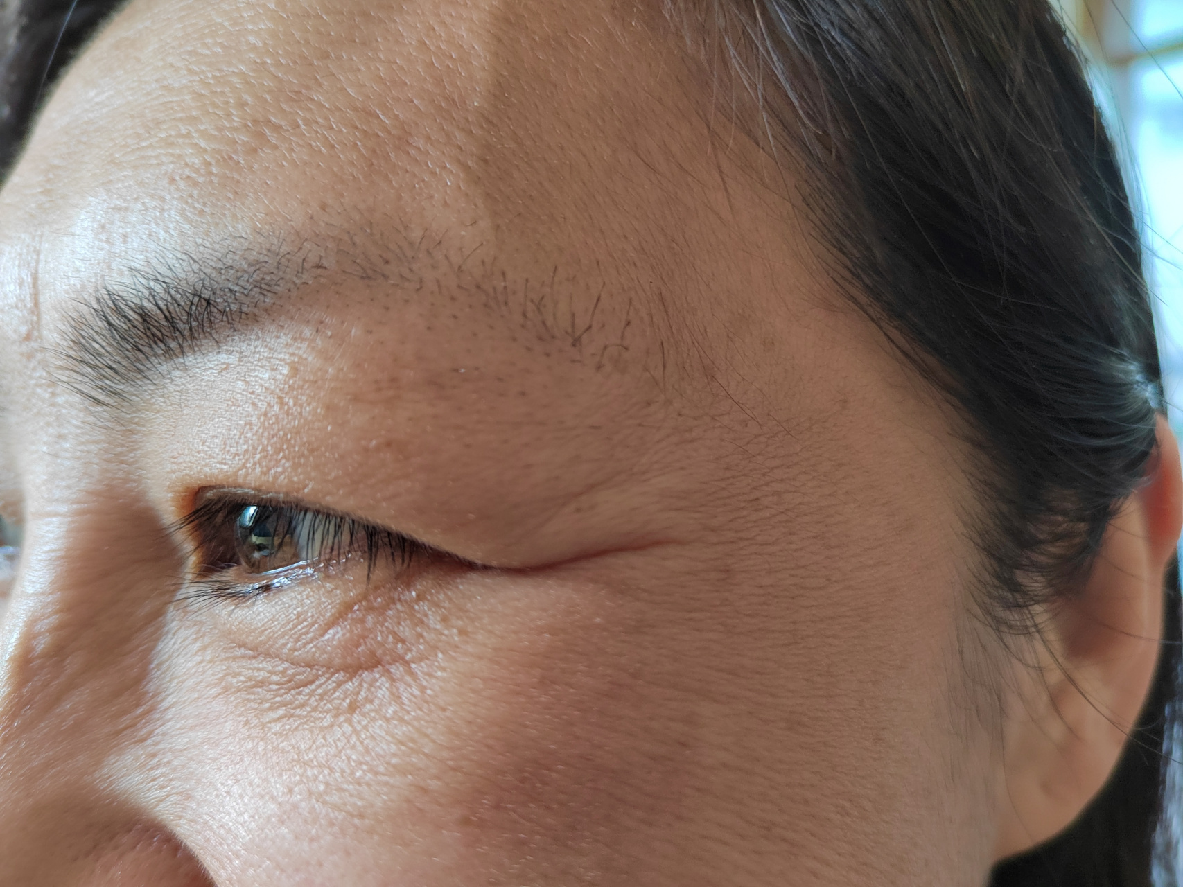 美容##肉毒素##解决皮肤问题专注皮肤美容