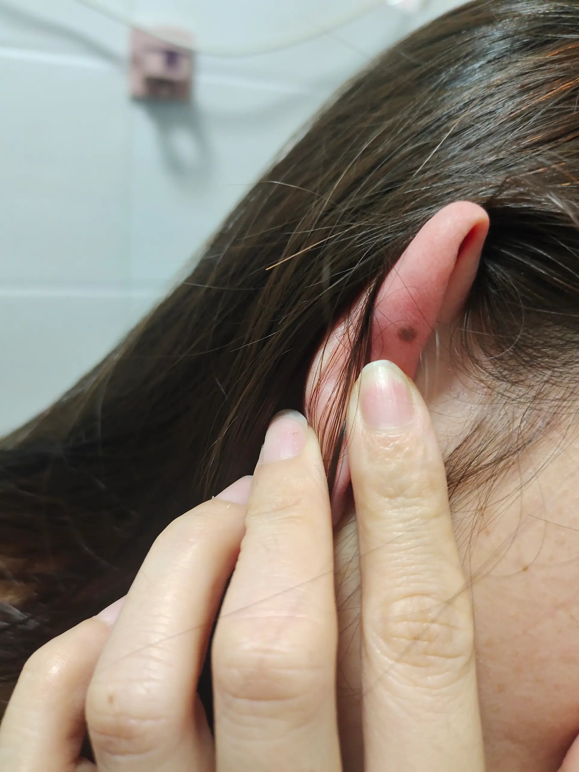 30年 ,没发现耳朵后面原来有颗痣