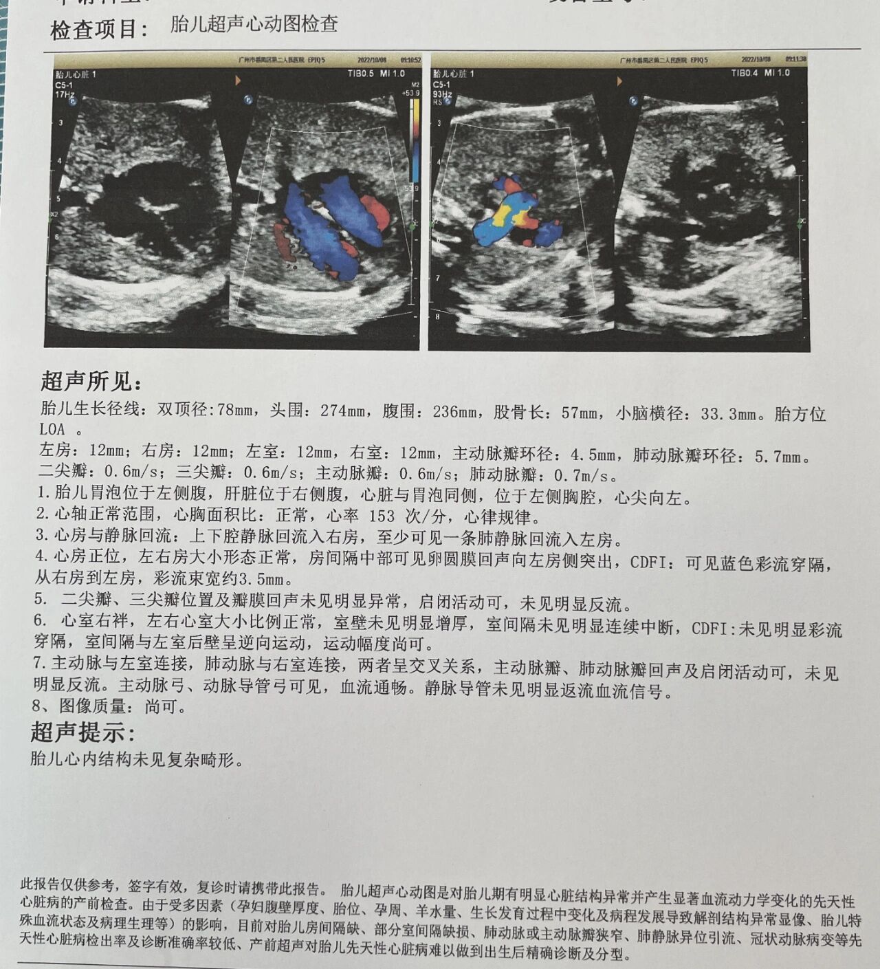 胎儿超声心动图   胎儿超声心动图检查一次性通过啦!