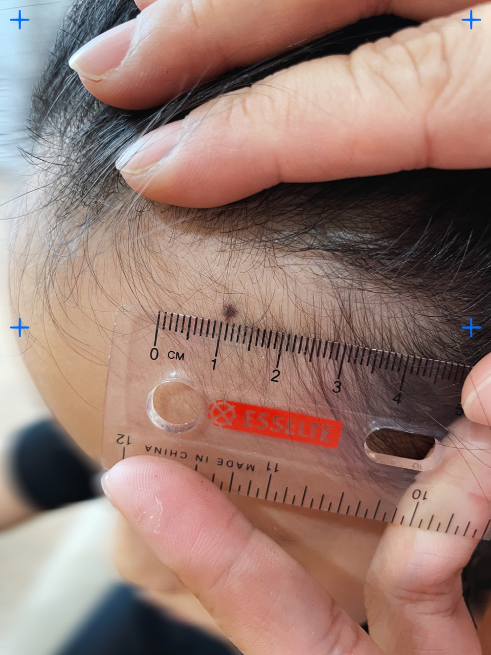 姐姐额头上有颗大黑痣,有凸起不规则.