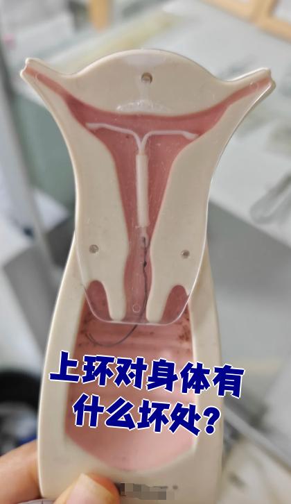 避孕环长期留在宫腔内,可能