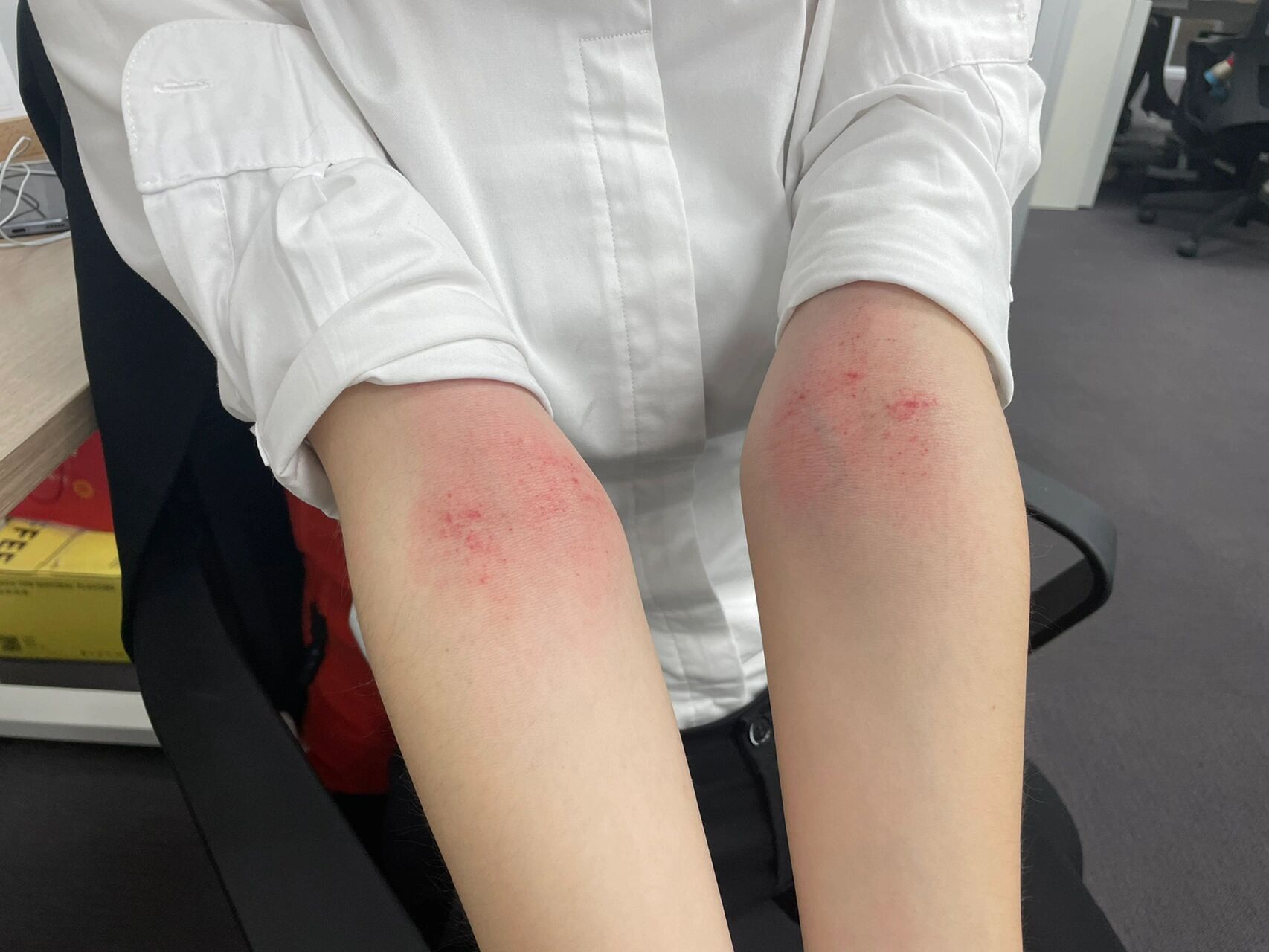 首次分享一个胃痛刮痧小方法  轻轻刮,刮出红点就好左右手各刮20下