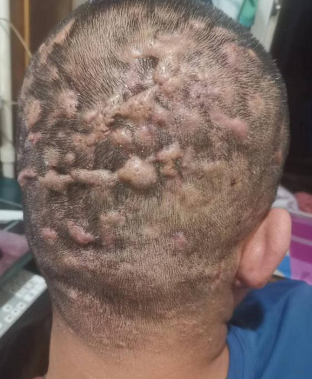 前不久,接诊了一位30岁的男性患者,他头上出现了满头脓包的情况(图1)
