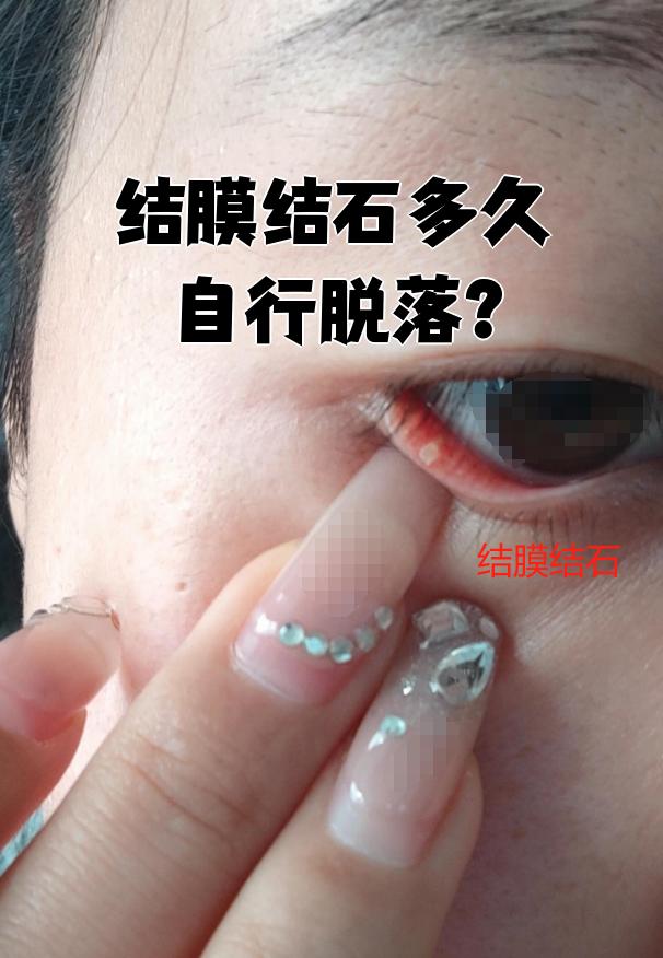 结膜结石多久自行脱落?