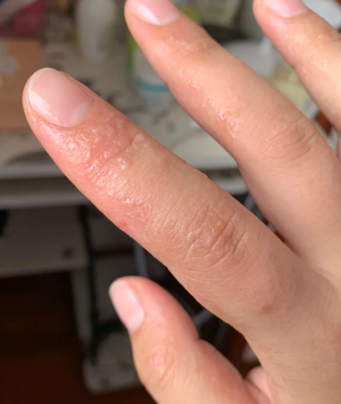 手指上长小水泡常见原因有三种:湿疹,手癣和汗疱疹