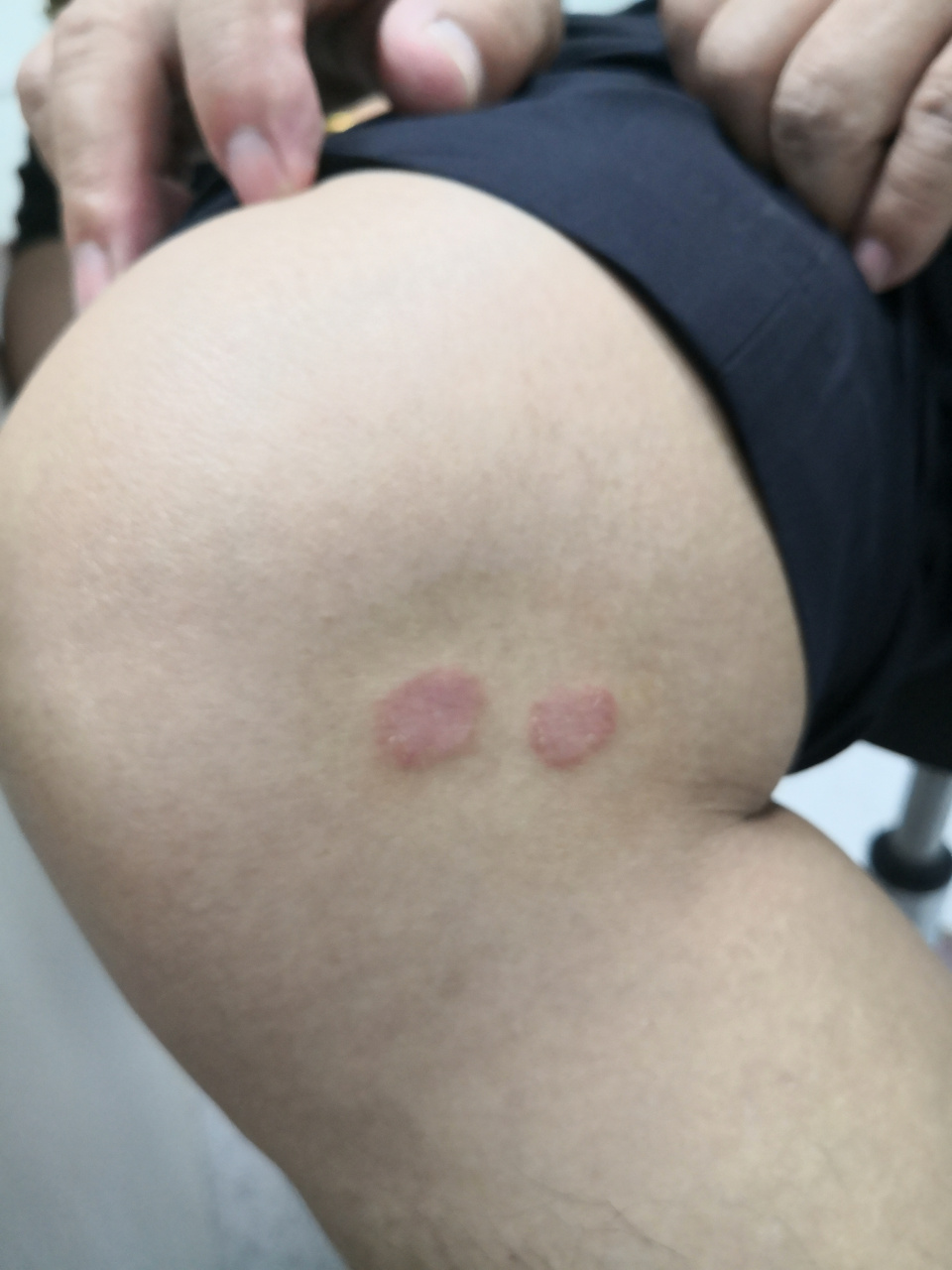 解决皮肤问题专注皮肤美容##牛皮癣##银屑病