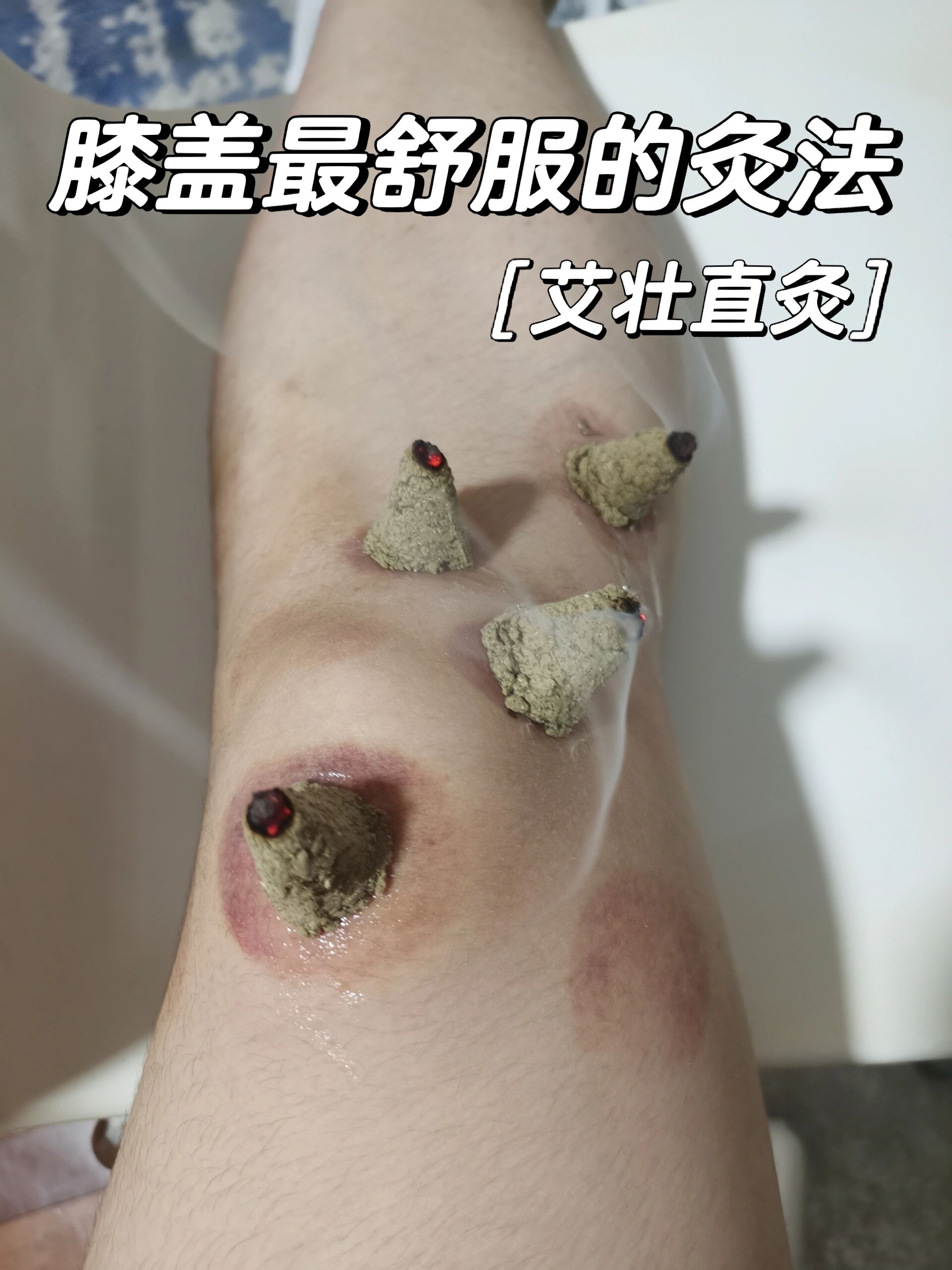 膝盖最舒服的灸法 分享我认为最舒服缓解膝盖寒的灸法 艾灸可以有很多