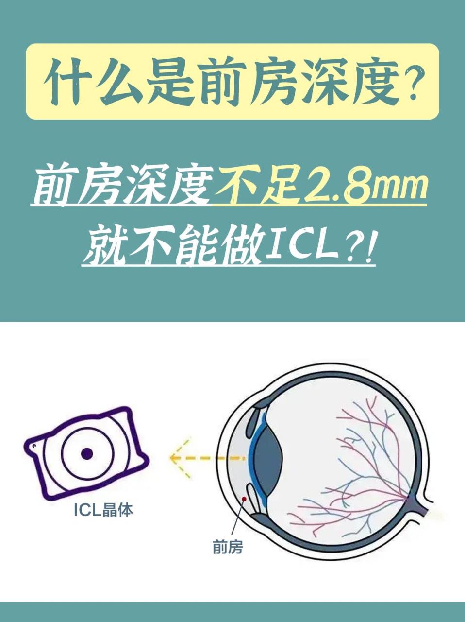 16615 什么是前方深度717171 	 26615 前房深度不足2.