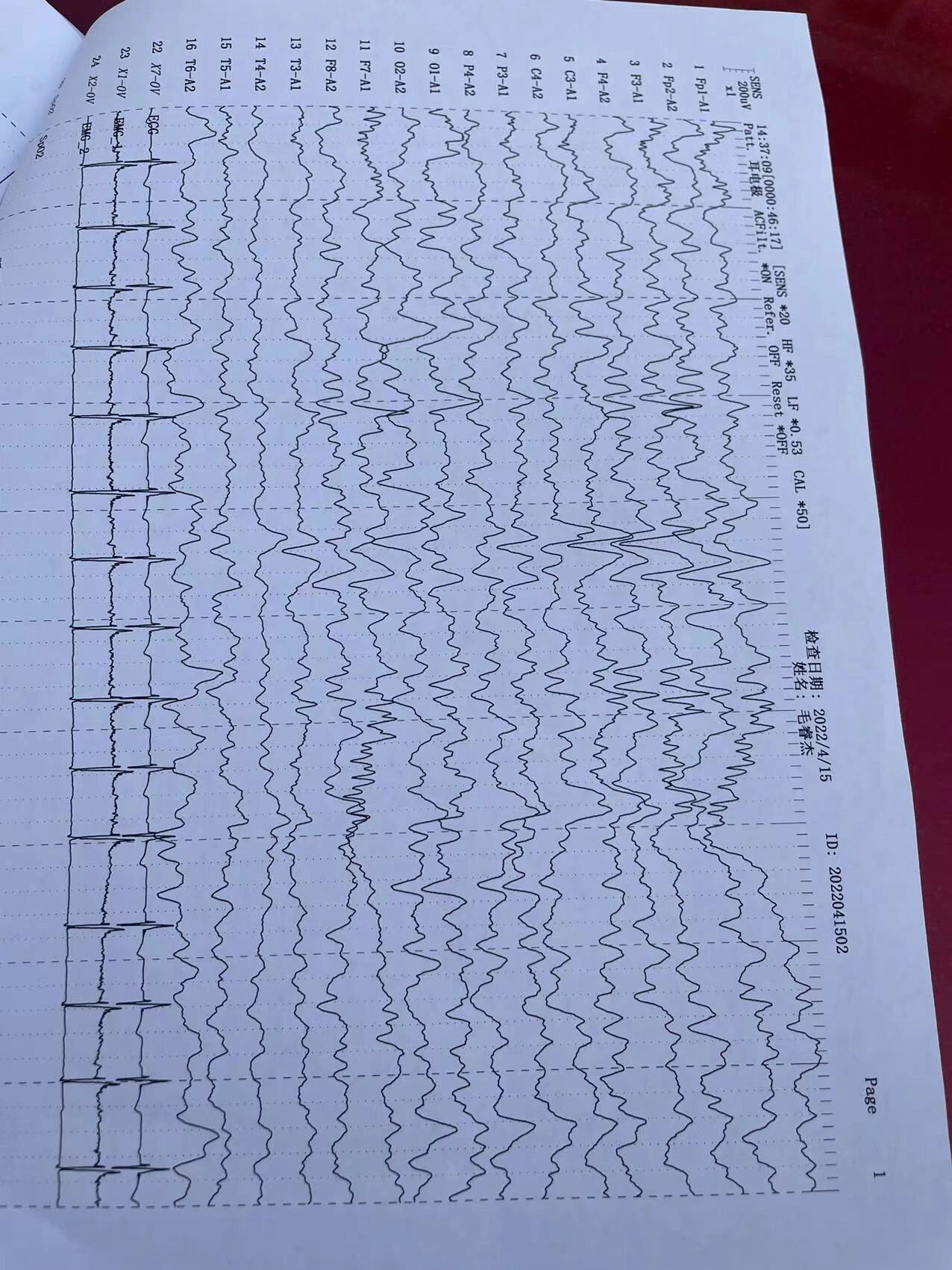 脑电图异常波解读图片
