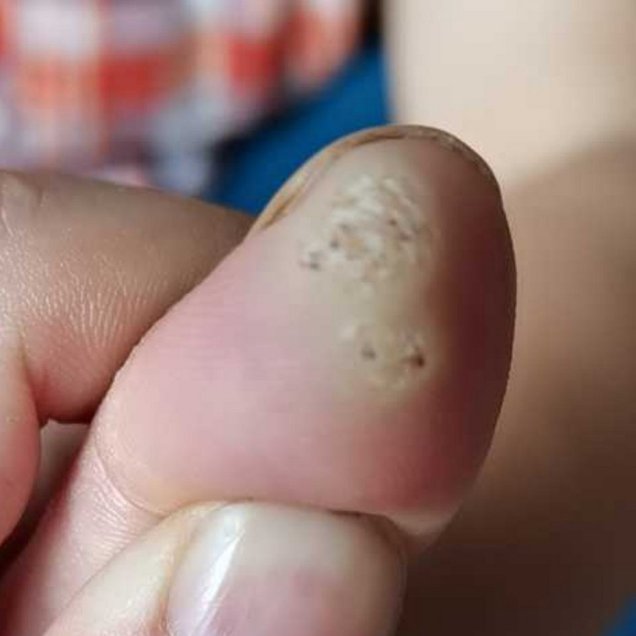 手部疣状物#寻常疣