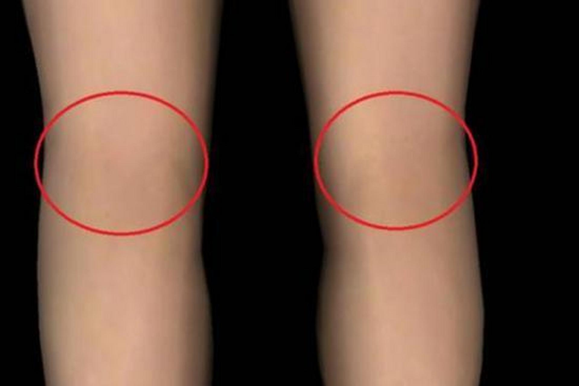 98膝盖后面的部位在医学上称为腘窝,结构比较复杂,俗称"腿凹"或"膝