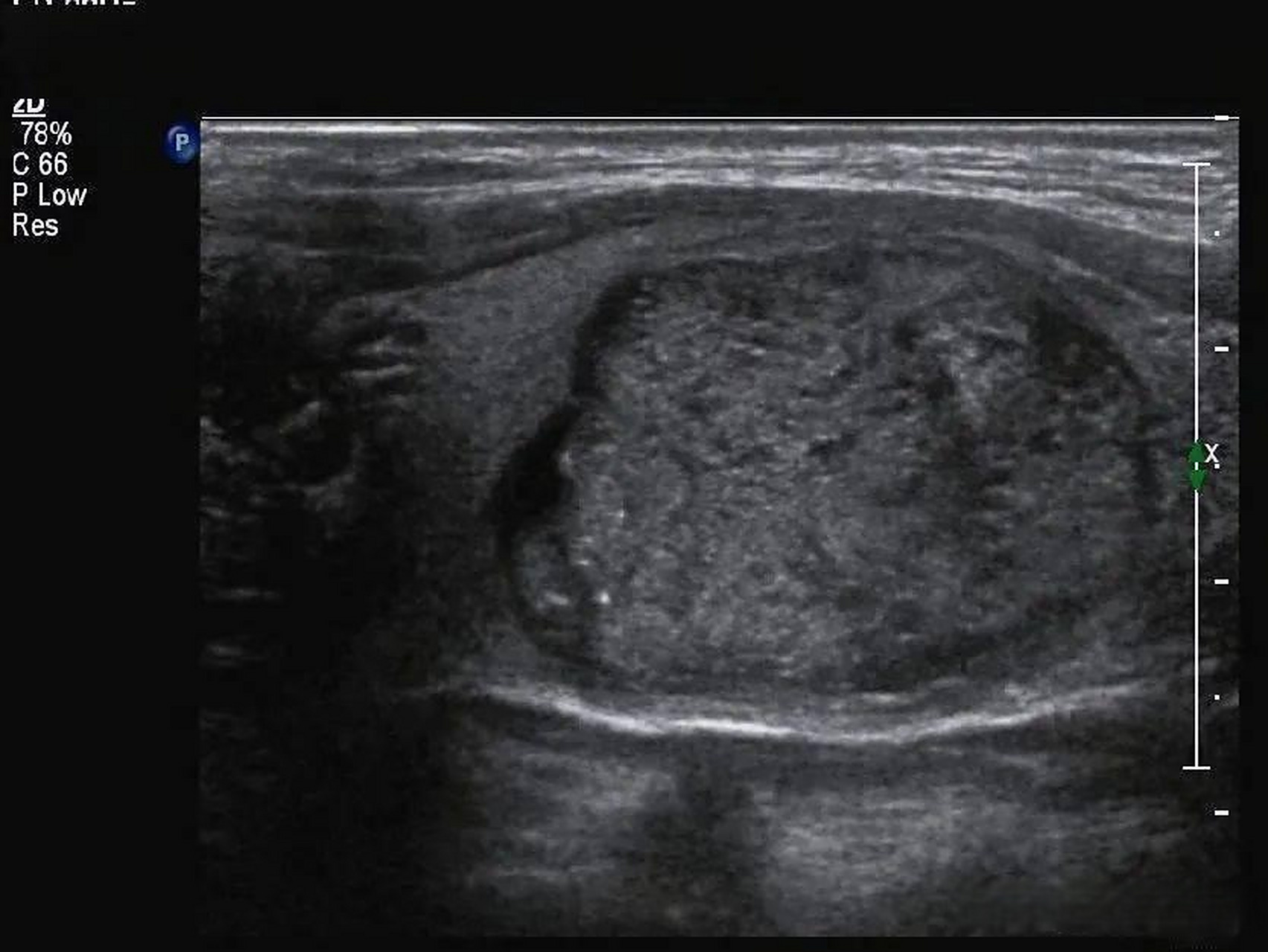 回声:描述结节中非钙化实性成分相对于周围甲状腺组织的回声水平