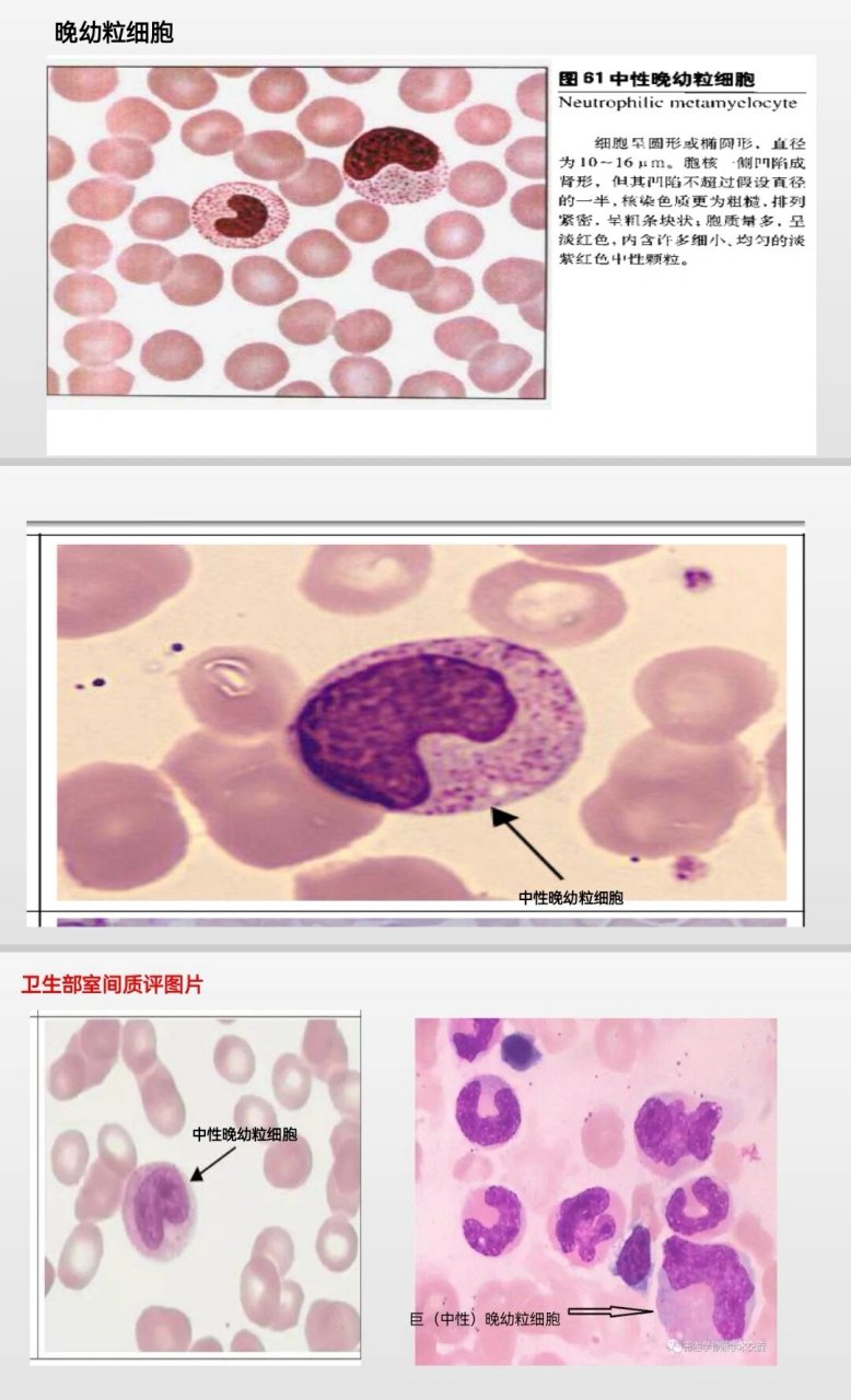 嗜碱性中幼粒细胞图片