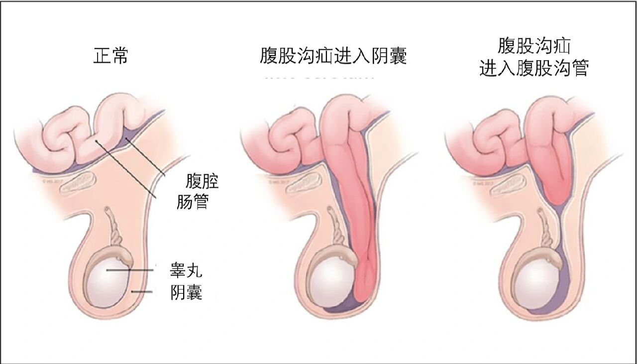 婴儿疝气的症状图片