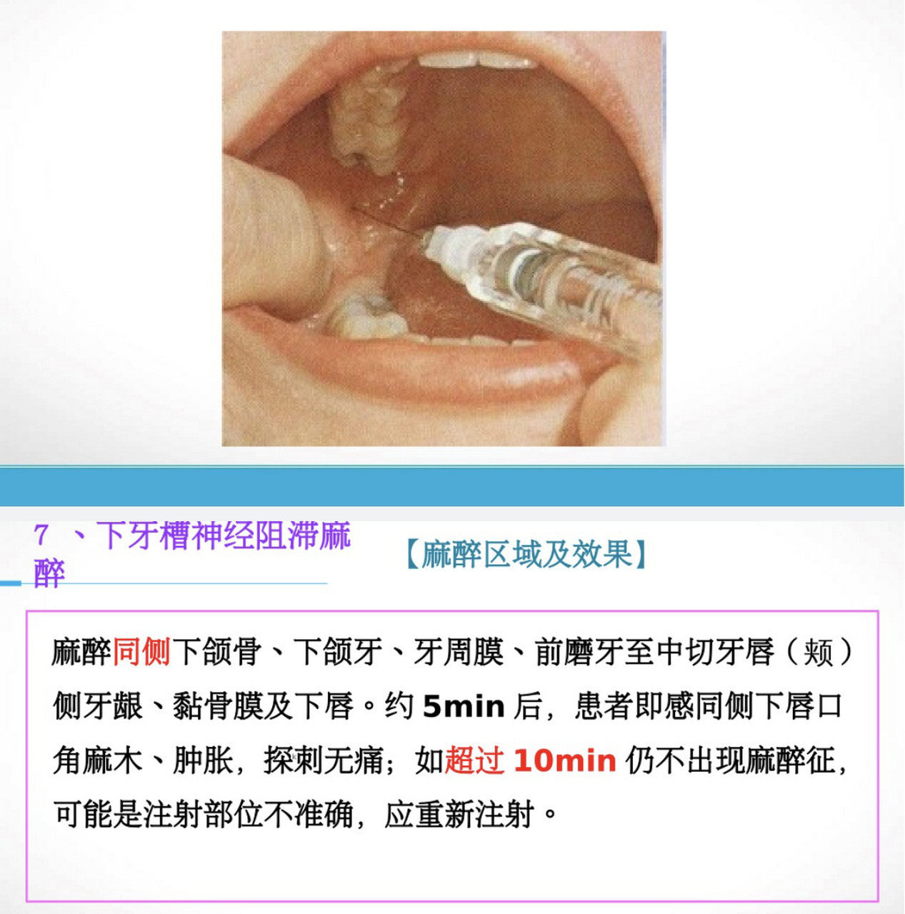 下牙槽神经阻滞麻醉口内注射法