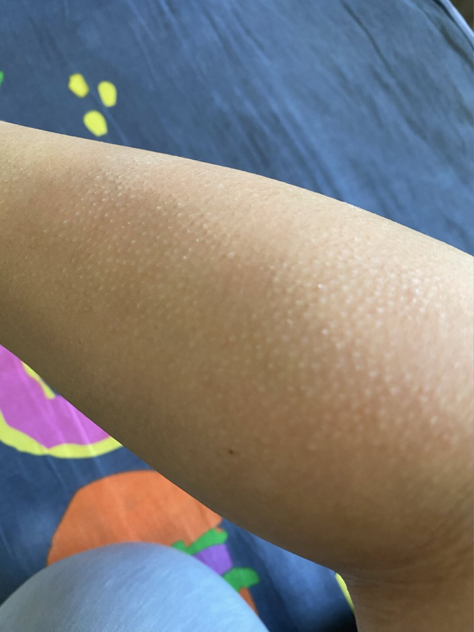 谁知道这胳膊上长的小疙瘩是什么 还痒