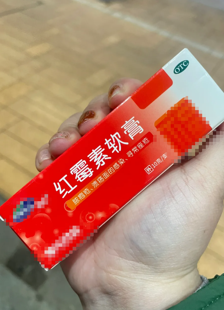 可以涂红霉素软膏消炎,效果不错