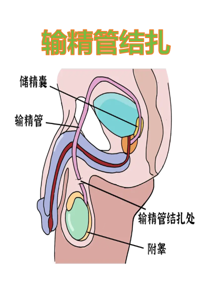 输精管结扎手术通常选择在输精管的精索部进行操作
