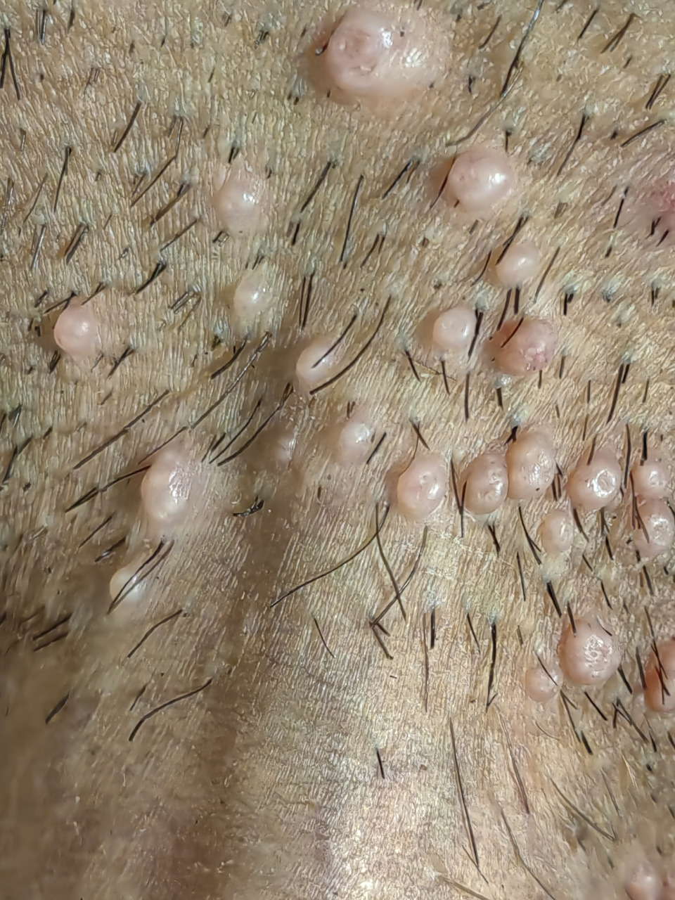 阴部传染性软疣症状 #传染性软疣