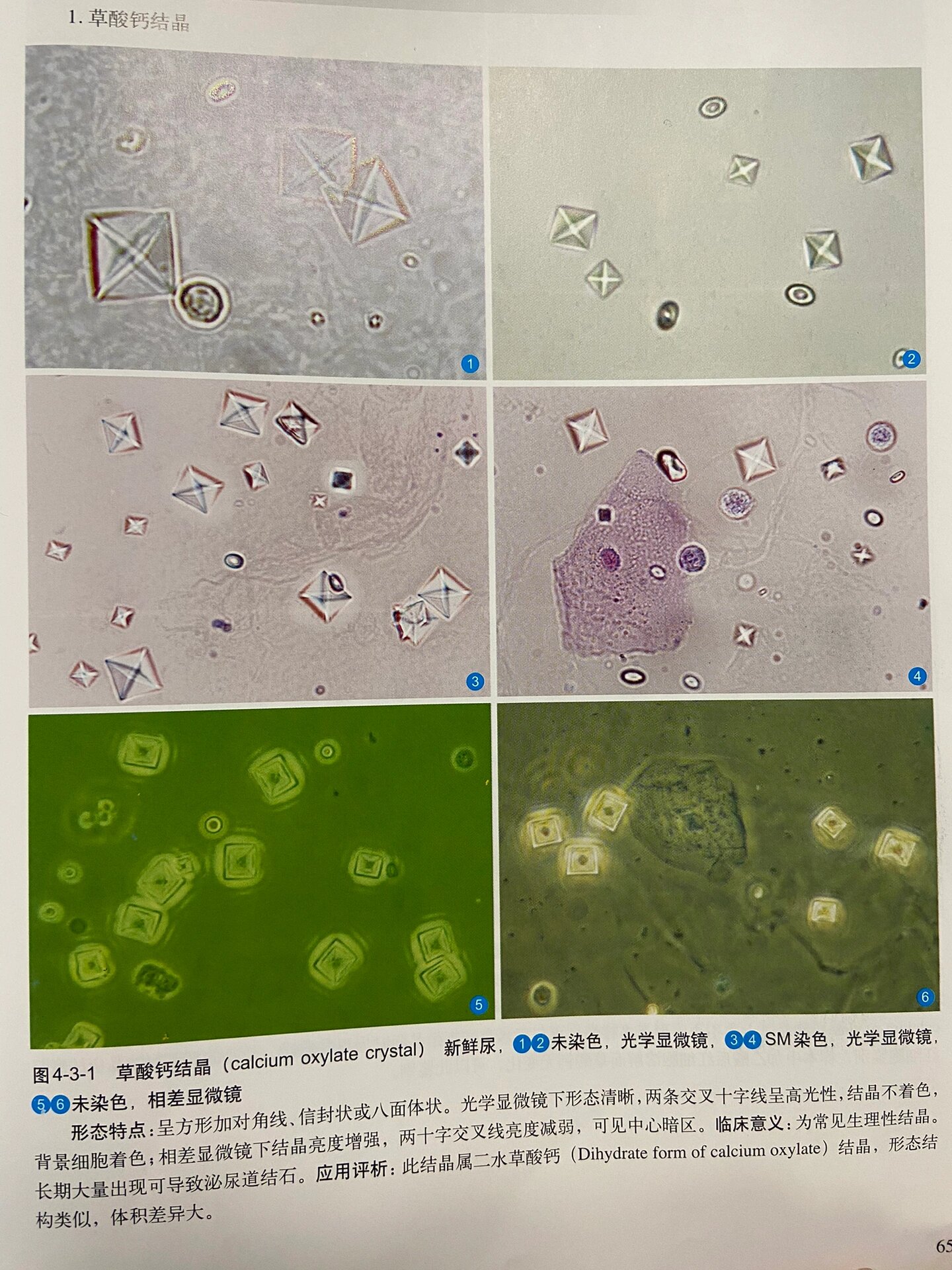 尿液结晶图片图谱图片