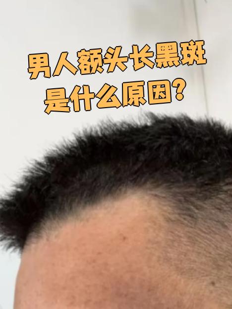 男人额头长黑斑常见原因有以下几种: