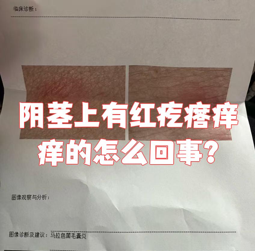 阴茎上出现红疙瘩并伴有瘙痒,最常见的原因是毛囊炎或湿疹