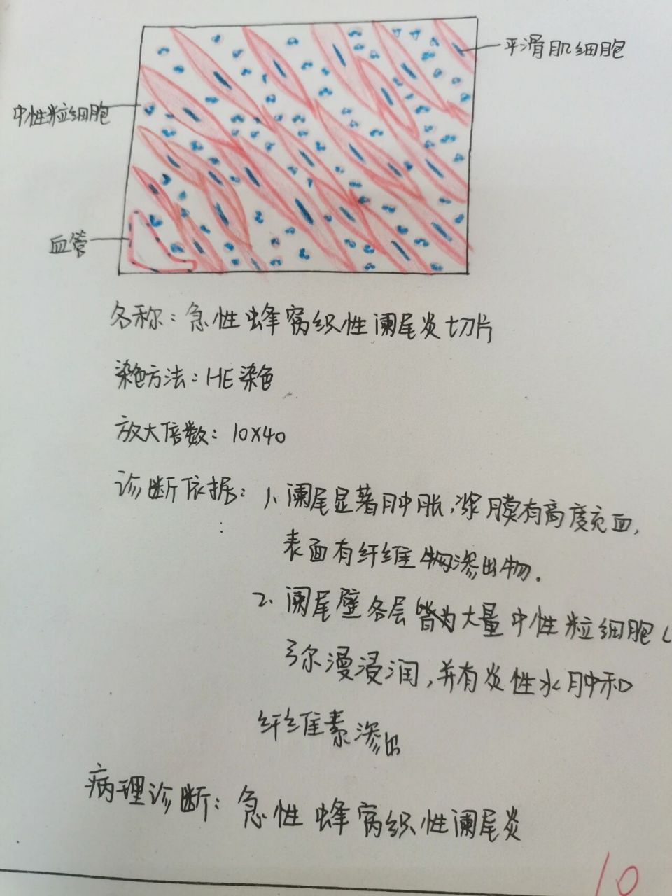 急性蜂窝织性阑尾炎切片红蓝铅笔绘图