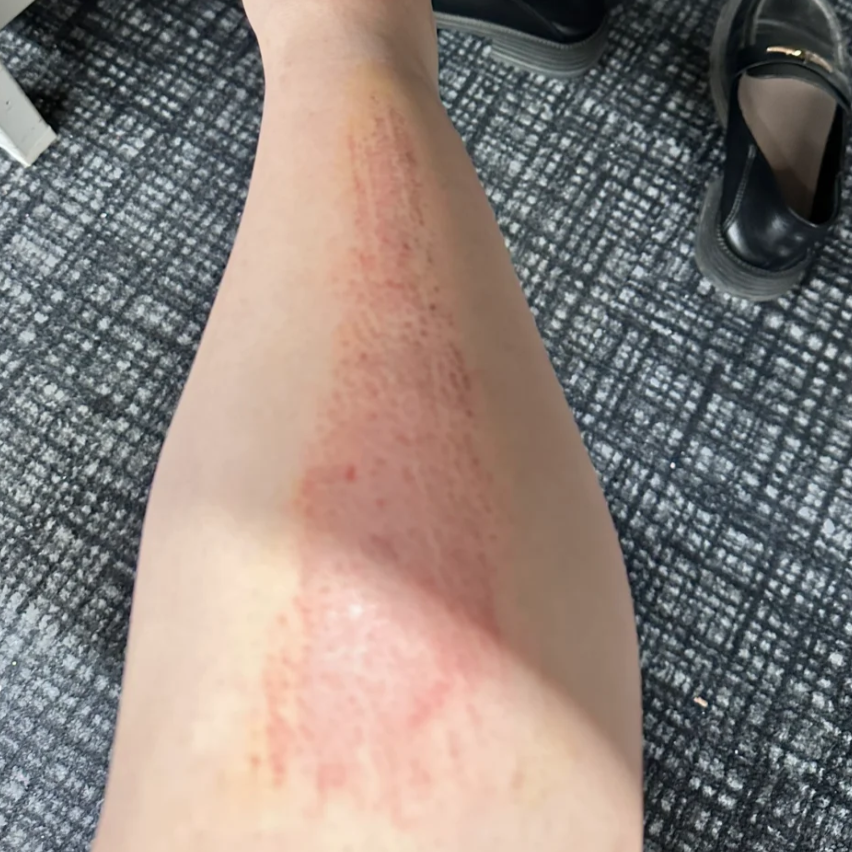 皮肤被划伤没有出血有红痕怎么处理?