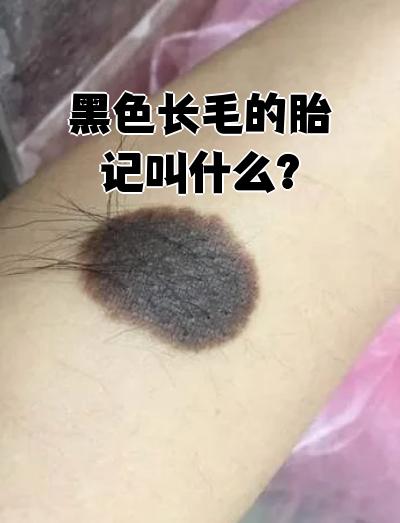 这种长黑毛的胎记医学上叫先天性黑痣,也有人叫它黑毛痣