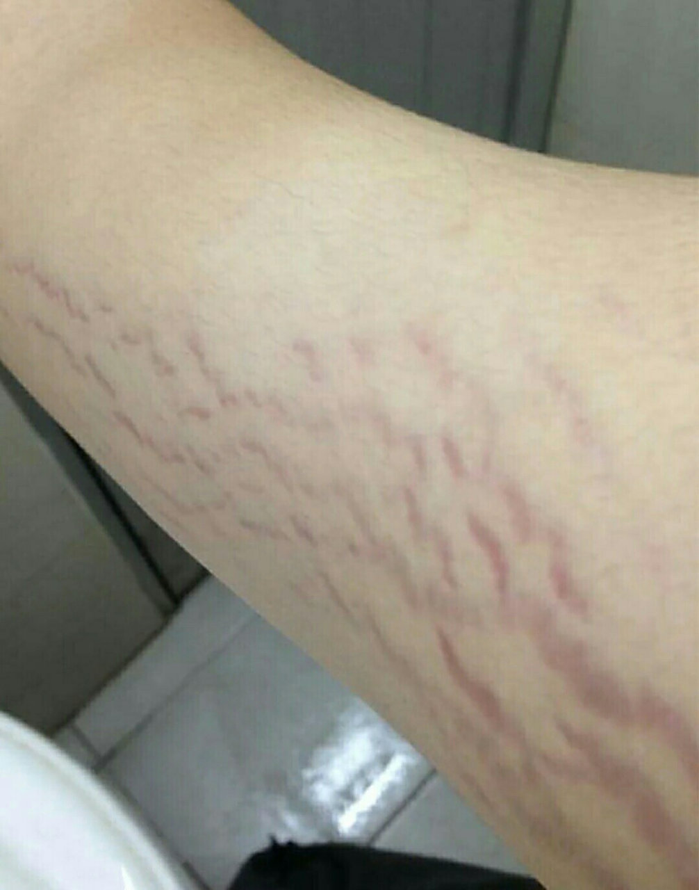 这东西我知道的晚了! 眼瞅着肥胖纹越长越多,我也无无计可施.