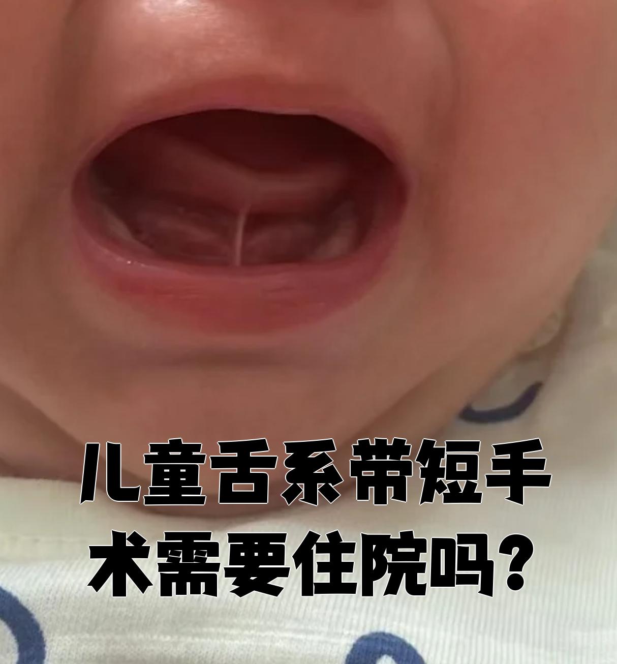 儿童舌系带短手术通常不需要住院