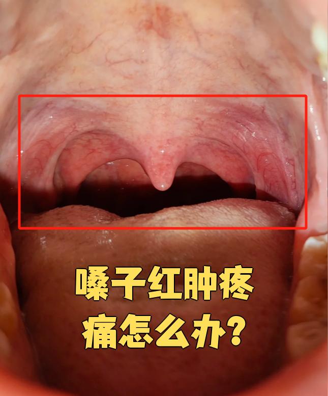 嗓子红肿疼痛最常见的原因是急性咽炎或急性扁桃体炎