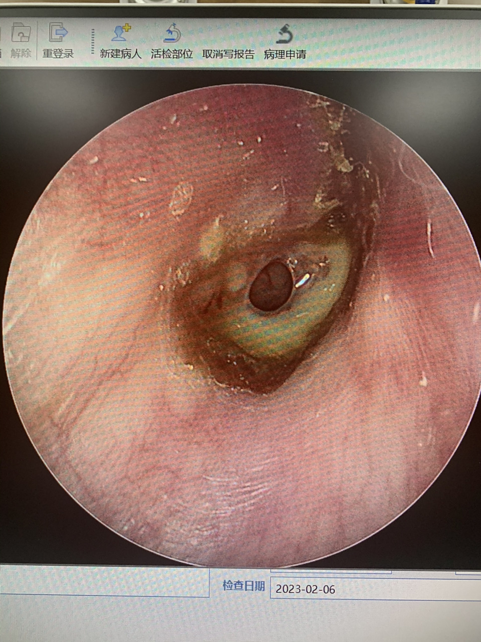 长年耳朵流水,需警惕 严重者可能需要手术,慢性化脓性中耳炎