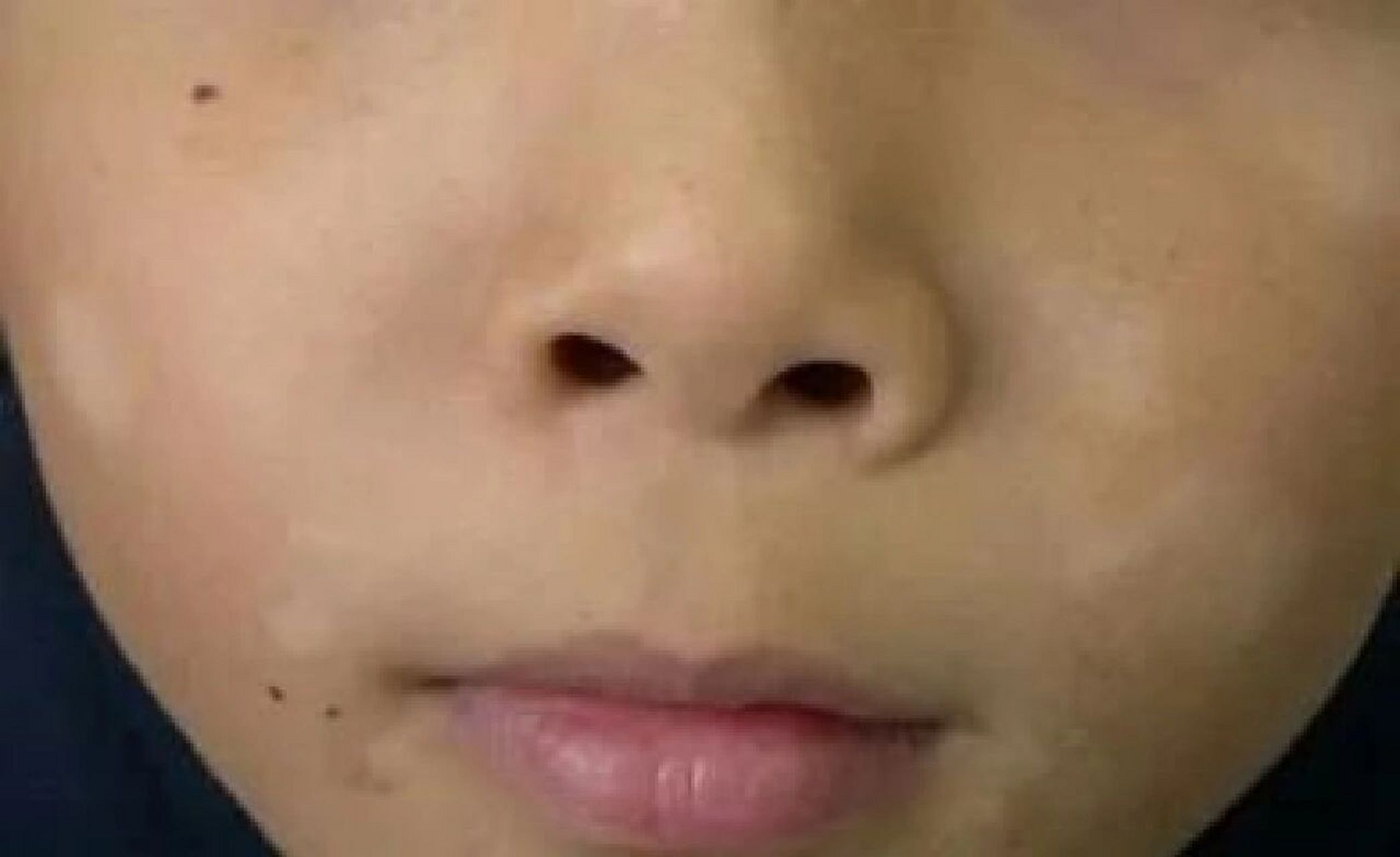 孩子脸上有白斑,很多家长的第一反应就是:"孩子怕是肚子里有虫吧"