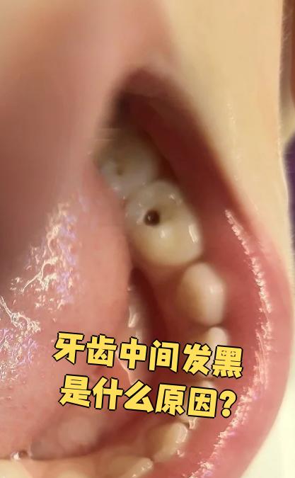 牙齿中间发黑常见原因有三个:色素沉着,蛀牙和牙龈萎缩