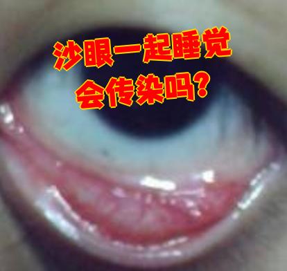 沙眼确实会传染,因为它是由沙眼衣原体引起的传染性结膜炎