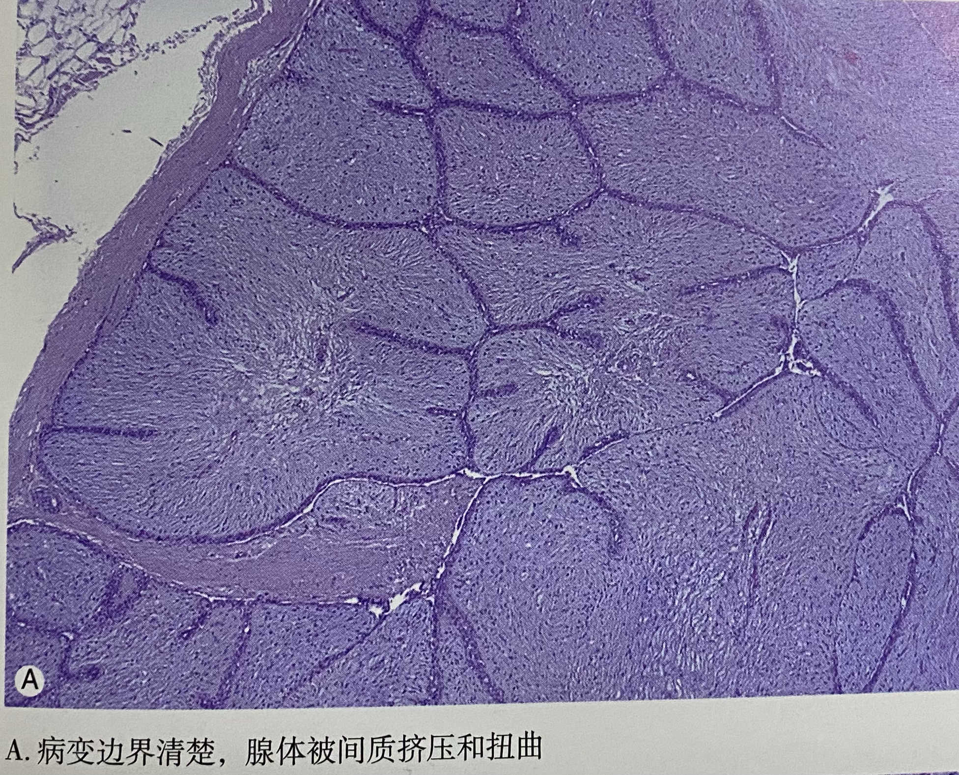 乳腺纤维腺瘤镜下观图片