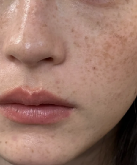 首先,紫外线照射是最常见的原因