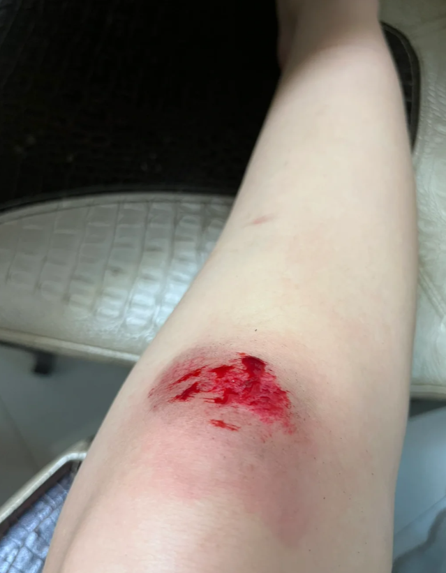 摔到膝盖后想判断骨头有没有受伤,主要看四个方面:受伤经过,症状