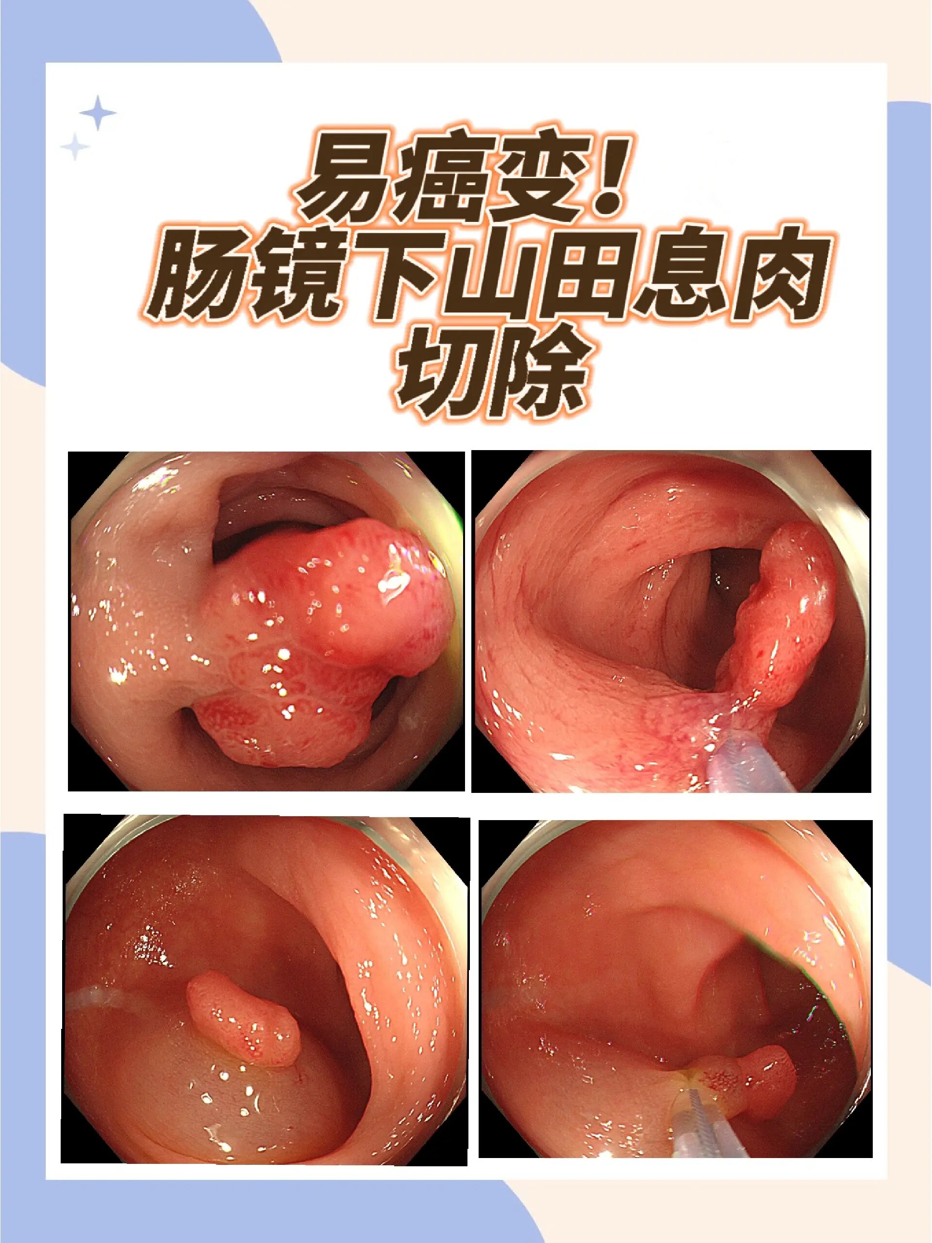 易ai变!肠镜下山田息肉切除