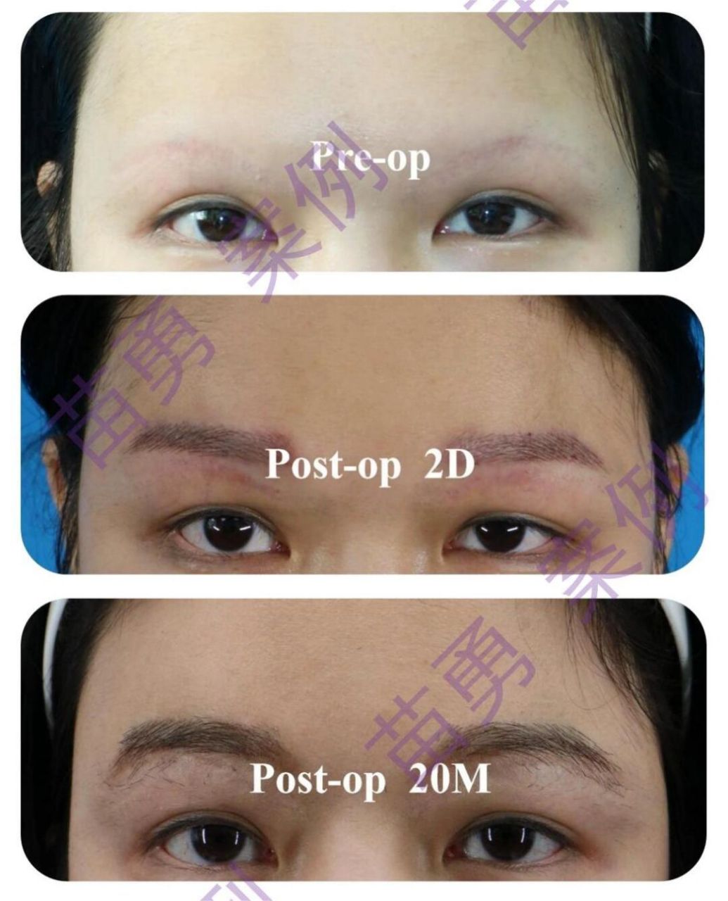 种植眉毛# #眉毛# #眉毛种植毛发移植技术# #半永久眉毛# #半永久