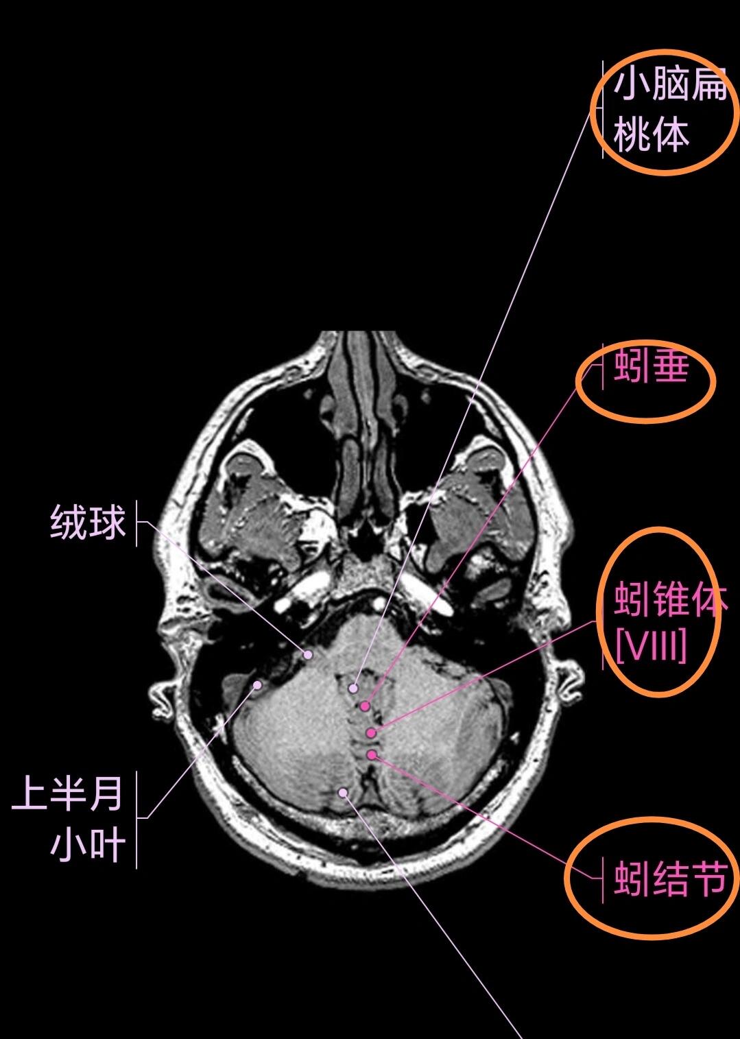 小脑蚓部正常影像解剖图片