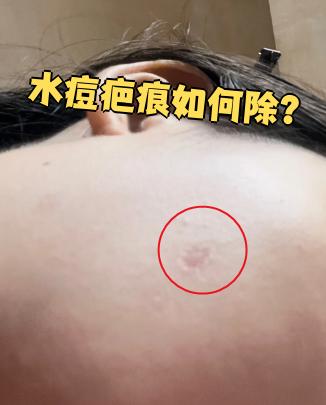 水痘疤痕可以用外用药或激光治疗
