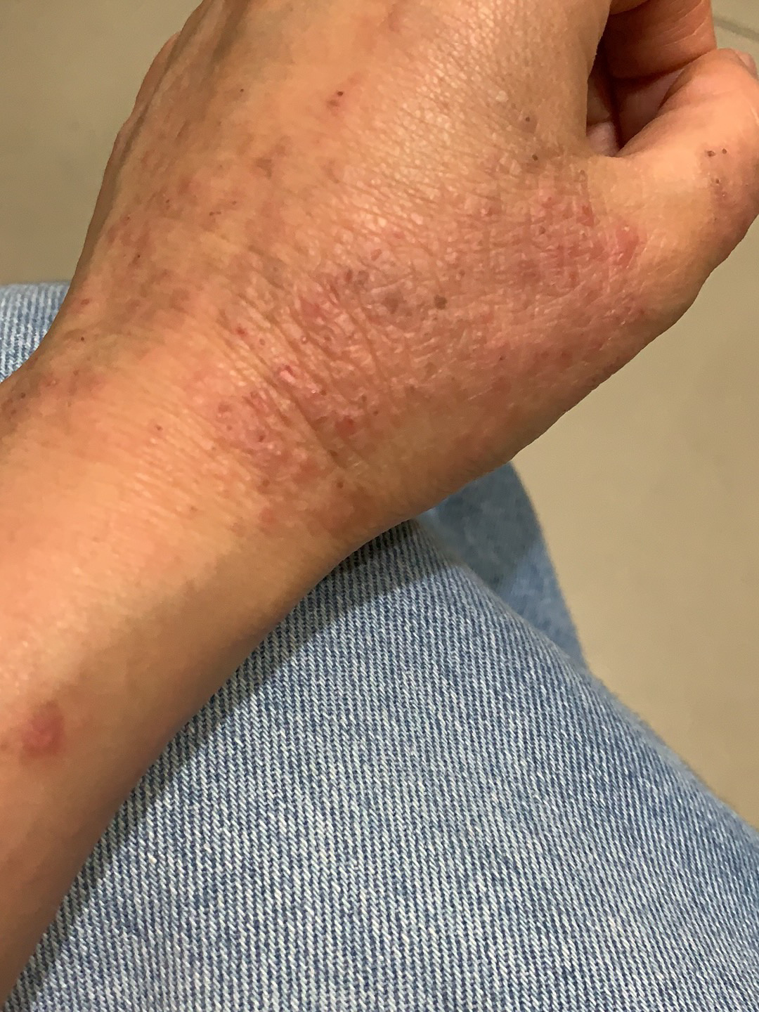 从小到大没有体验过过敏的滋味 也不是过敏皮肤 偶然发现自己甲醛过敏